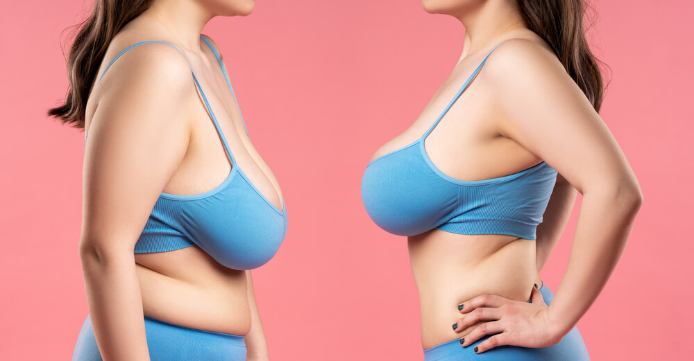 Will I Have Saggy Boobs After Weight Loss? - Suffolk Breast